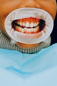 Full Mouth Rehabilitation