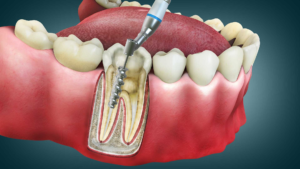 Root Canal Treatment and Endodontics